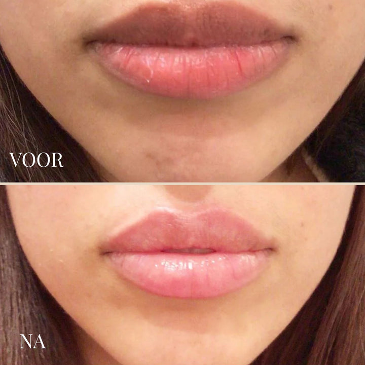 Lemon Lip Balm - Brightening Lip Treatment for Dark Lips 5