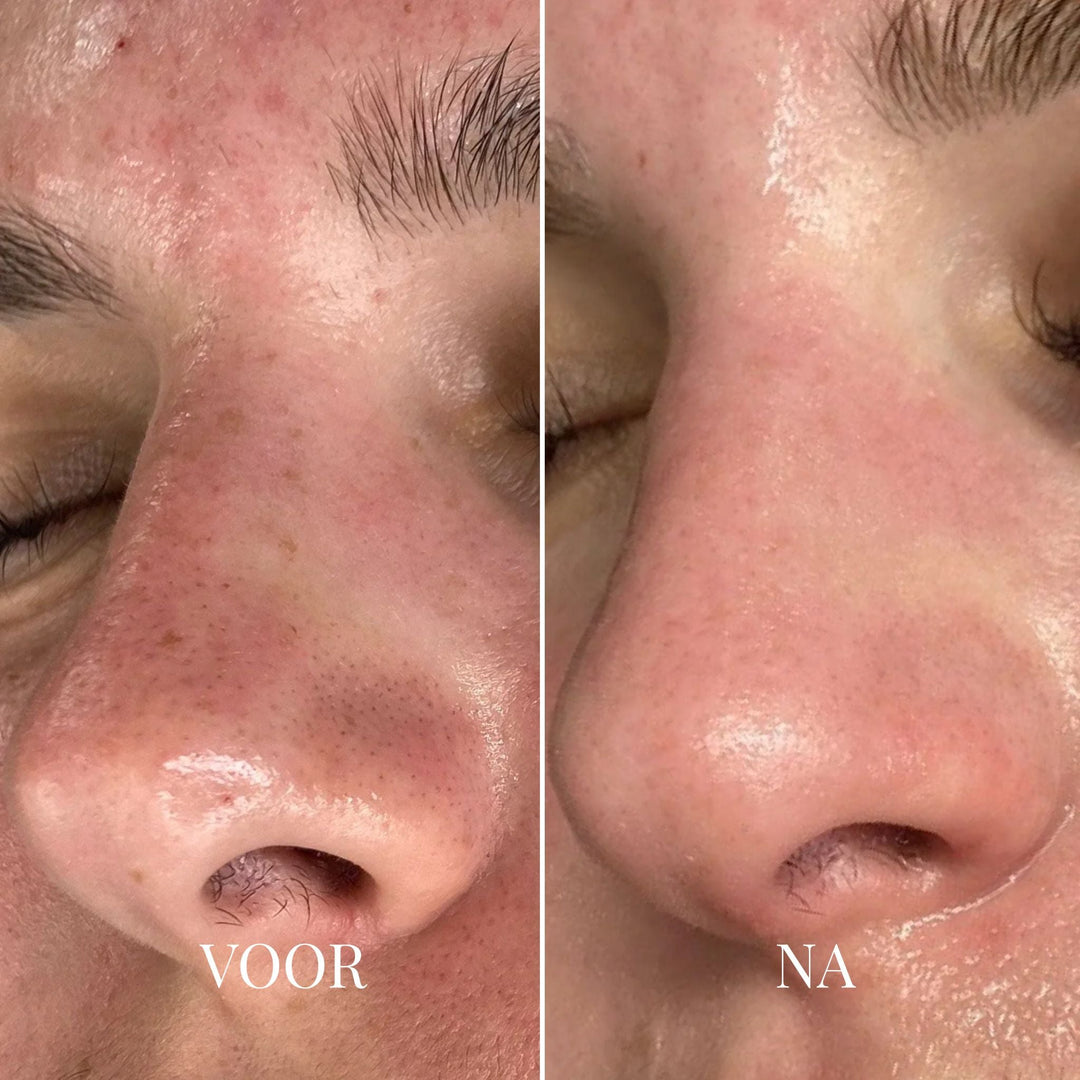 Blackhead Remover Vacuum Pore Cleanser with 3 Suction Levels 2