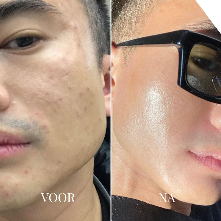 Blackhead Remover Vacuum Pore Cleanser with 3 Suction Levels 7