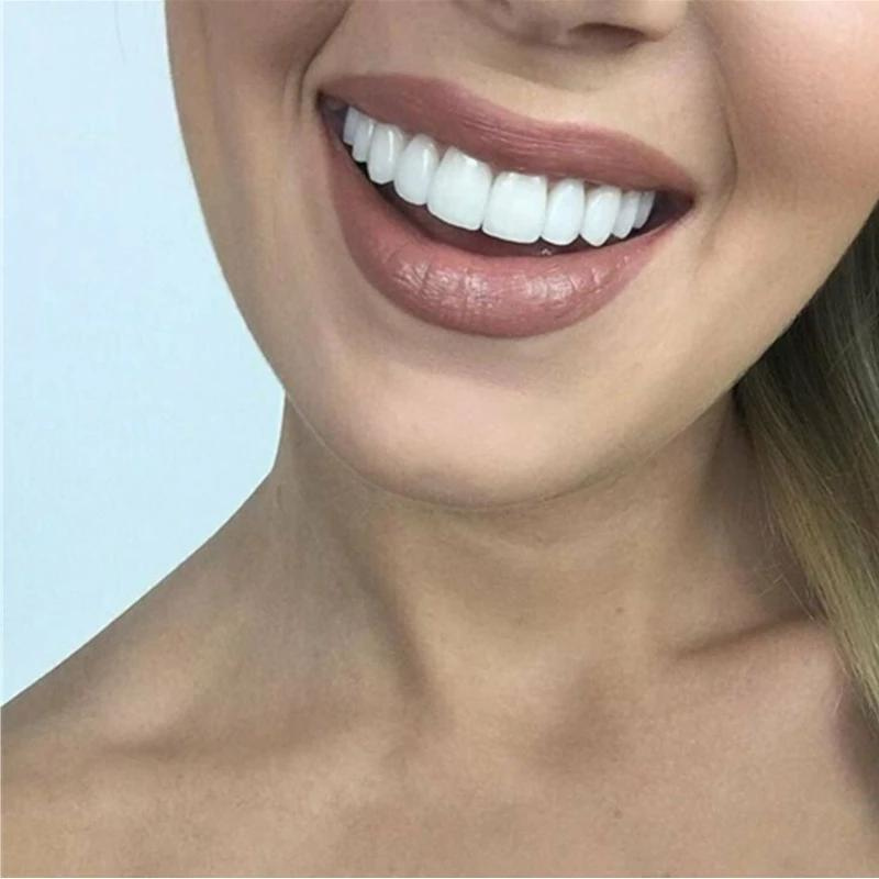 Snap-On Veneers for a Natural-Looking White Smile, Reusable and Glue-Free 3