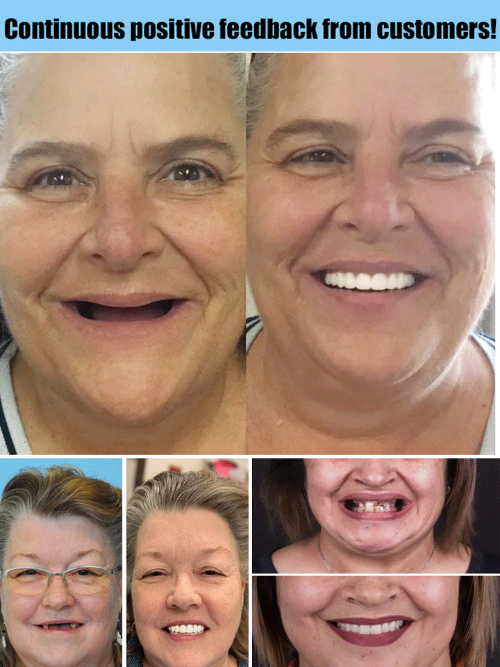 Flexible Denture Set for Upper & Lower Jaw – Reusable & Custom-Fit 3