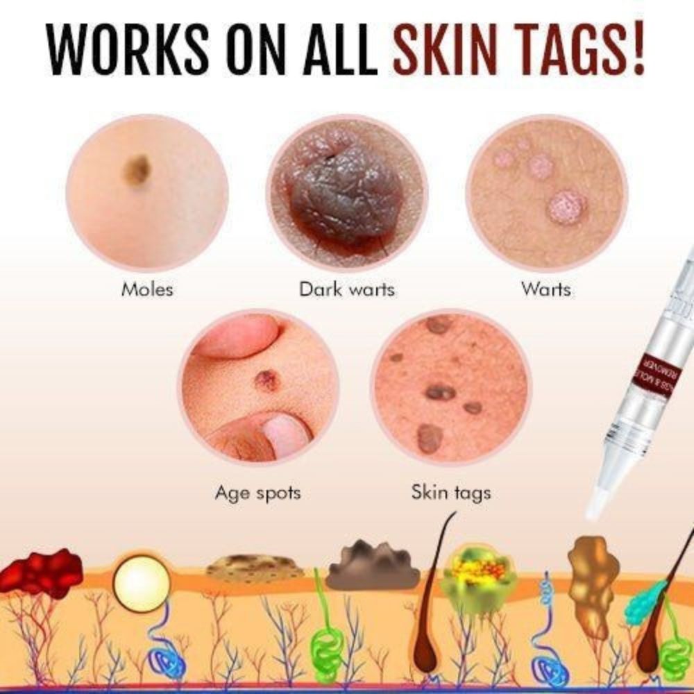 Effective Skin Tag & Mole Remover for Clear Skin 2