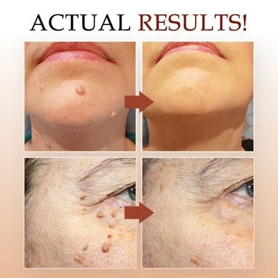 Effective Skin Tag & Mole Remover for Clear Skin 4
