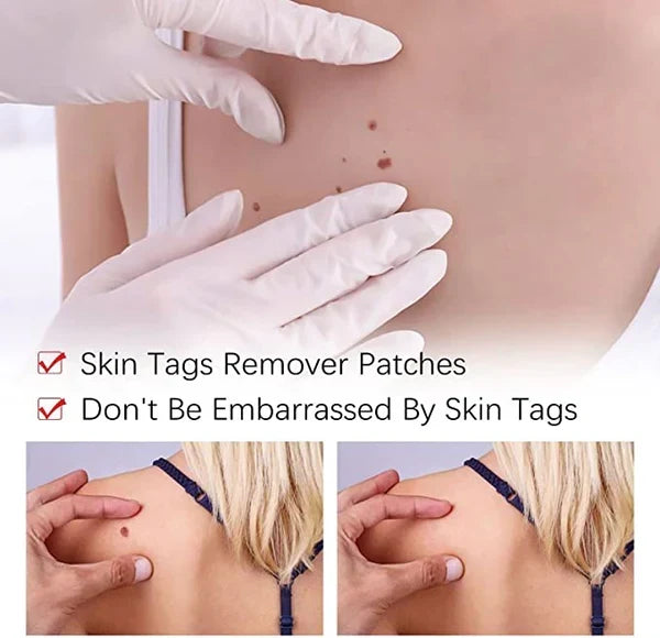 Effective Skin Tag & Mole Remover for Clear Skin 5
