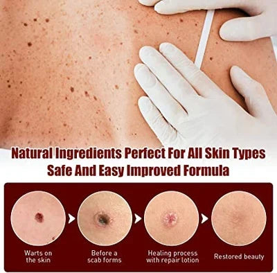 Effective Skin Tag & Mole Remover for Clear Skin 8