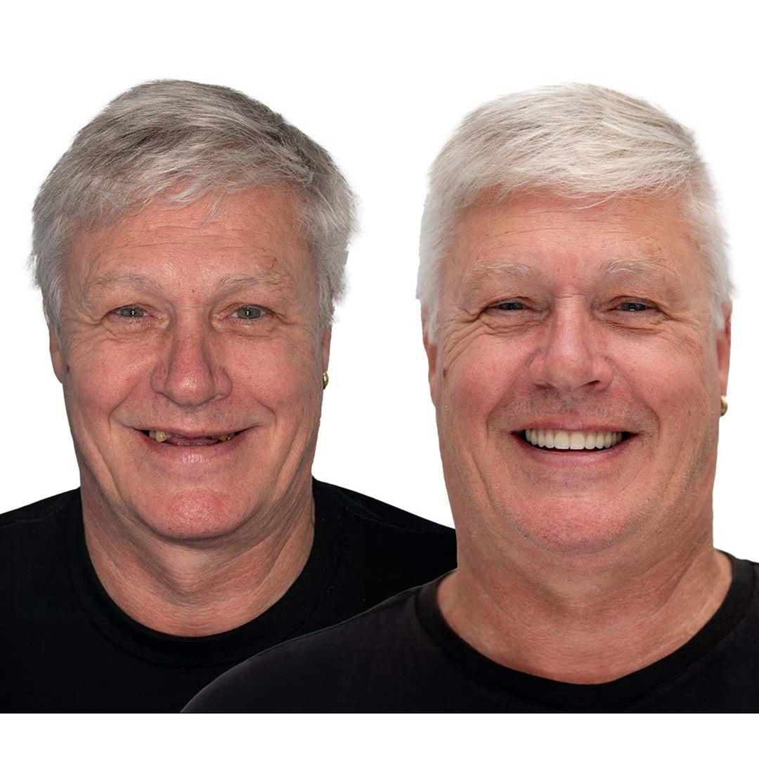 Removable Full Arch Denture Set with Flexible Cushion Grip for Everyday Wear 5