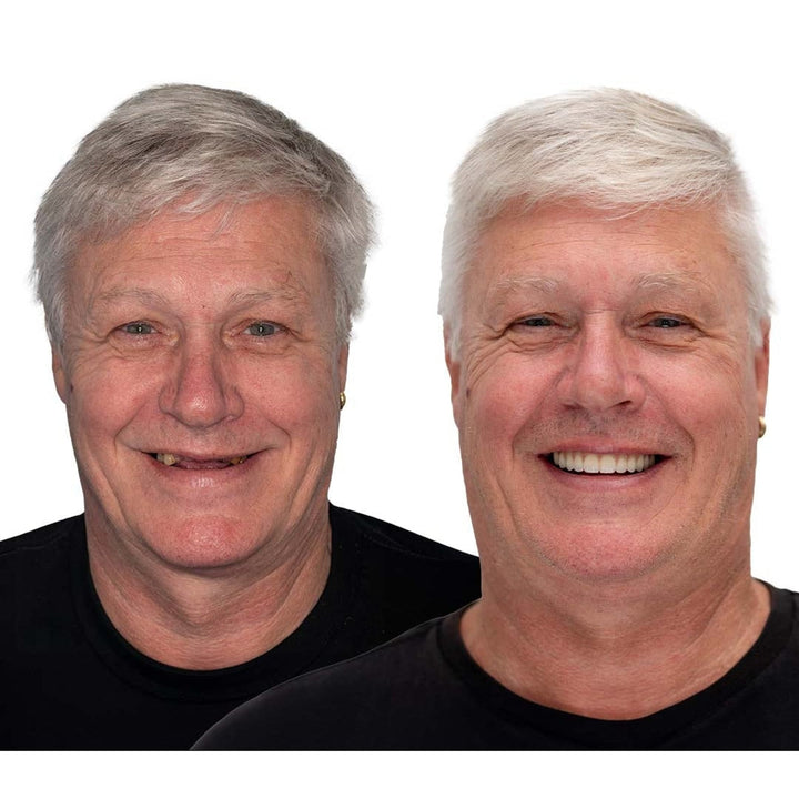 Removable Full Arch Denture Set with Flexible Cushion Grip for Everyday Wear 5